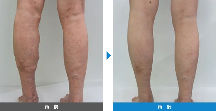 下肢静脈瘤の症例写真