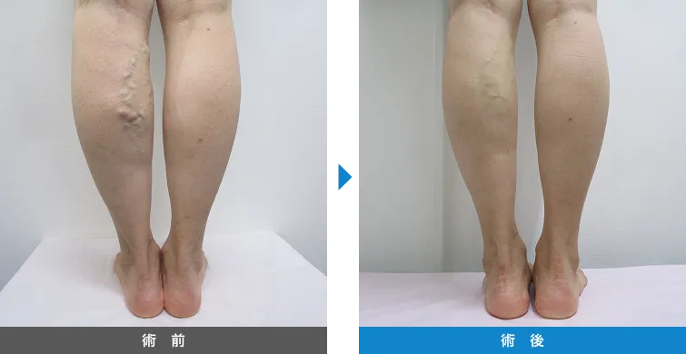 下肢静脈瘤の症例写真