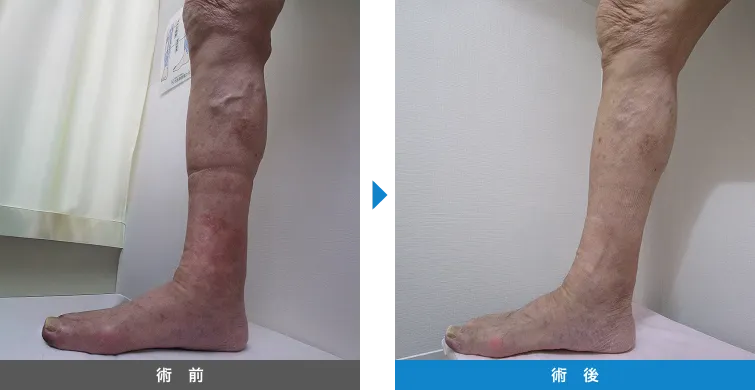 下肢静脈瘤の症例写真