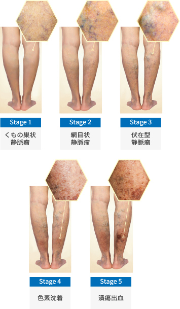 下肢静脈瘤のステージ