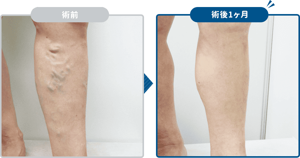 高周波治療の結果
