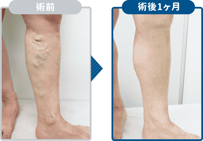 高周波治療の結果