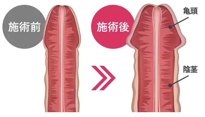 メンズ増大PRPG注射の施術前後