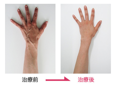 ハンドベイン治療 症例写真