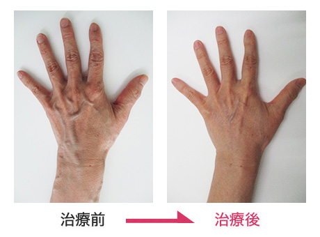 ハンドベイン治療 症例写真