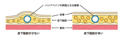 皮下脂肪量の減少