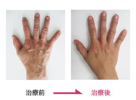 ハンドベイン治療 症例写真