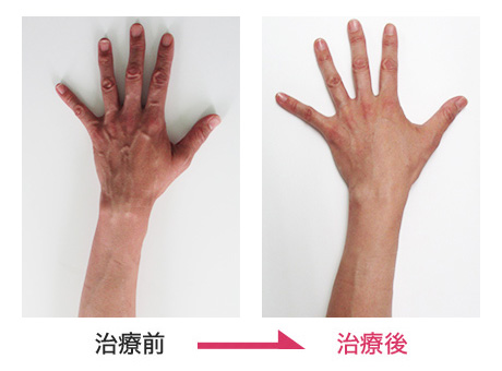 ハンドベイン治療 症例写真