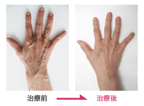 ハンドベイン治療 症例写真