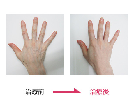ハンドベイン治療 症例写真