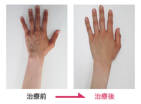ハンドベイン治療 症例写真