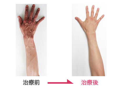 ハンドベイン治療 症例写真