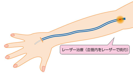 レーザー治療