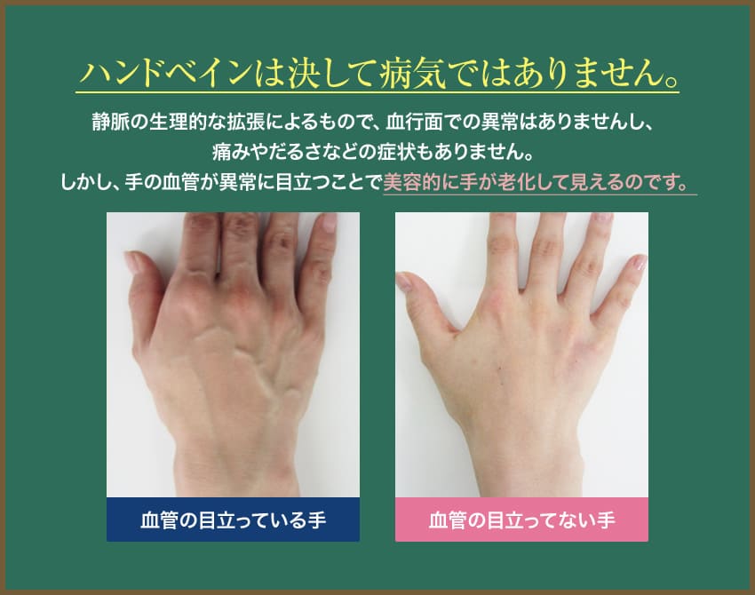ハンドベインは決して病気ではありません。