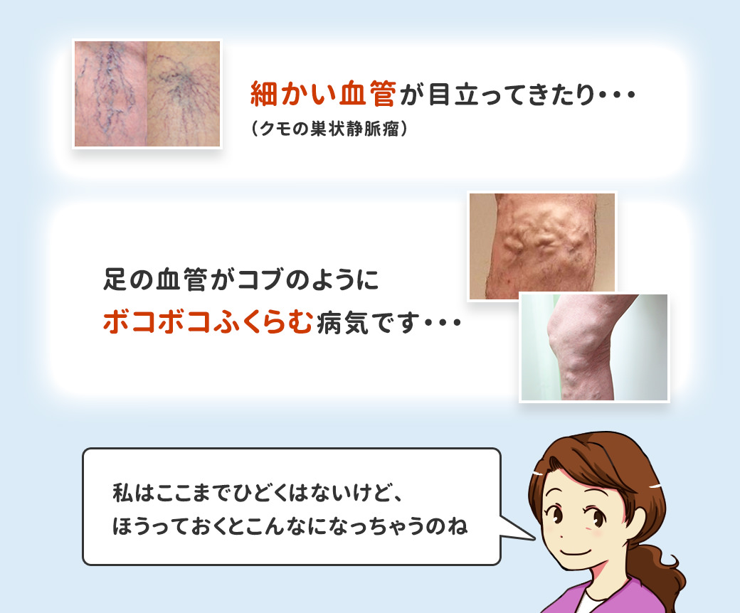 細かい血管が目立ってきたり・・・(クモの巣状静脈瘤)足の血管がコブのようにボコボコふくらむ病気です・・・