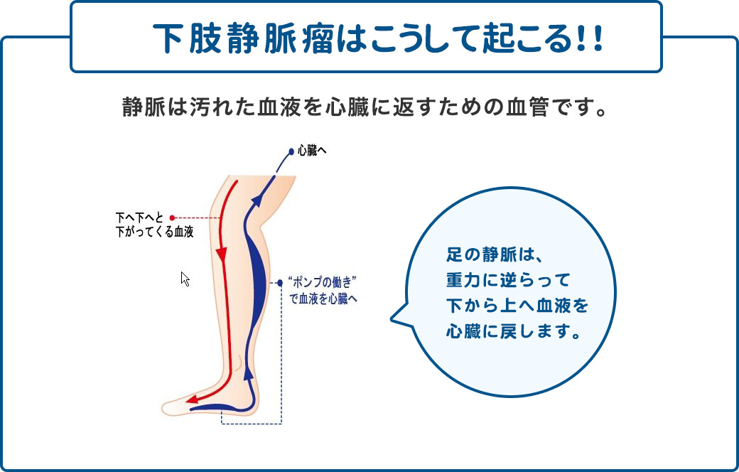 下肢静脈瘤はこうして起こる!!