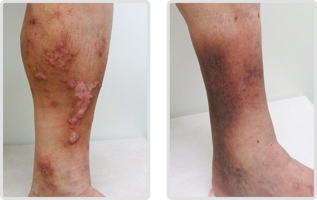 色素沈着 脂肪皮膚硬化症