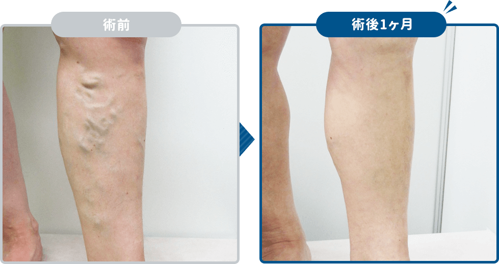 高周波治療の結果