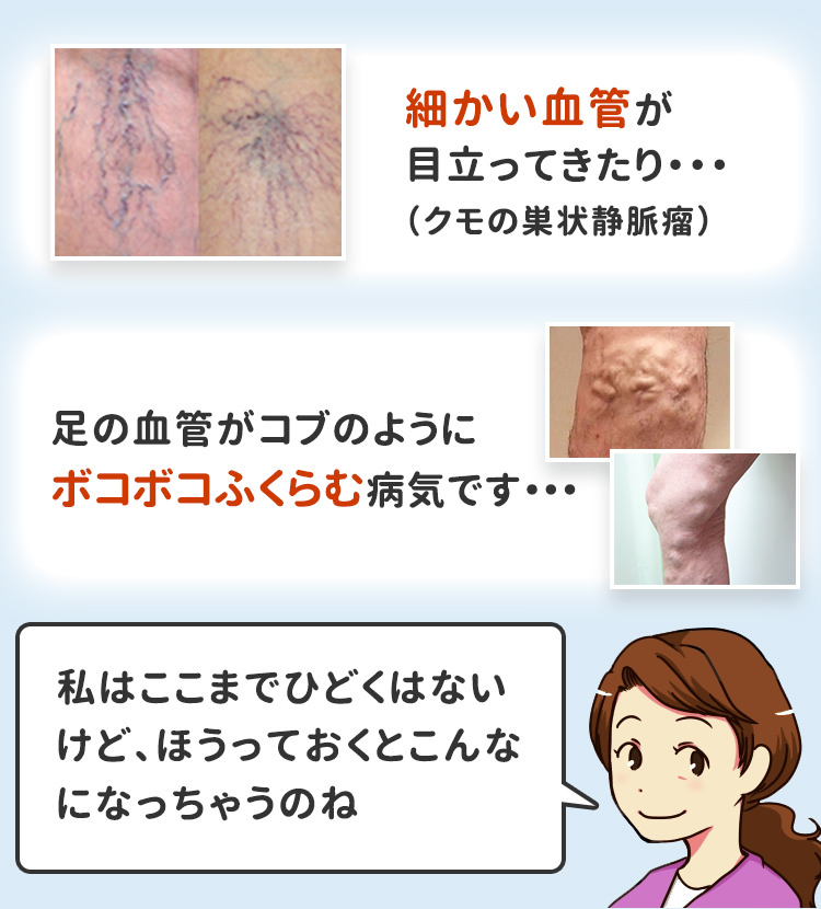 細かい血管が目立ってきたり・・・(クモの巣状静脈瘤)足の血管がコブのようにボコボコふくらむ病気です・・・