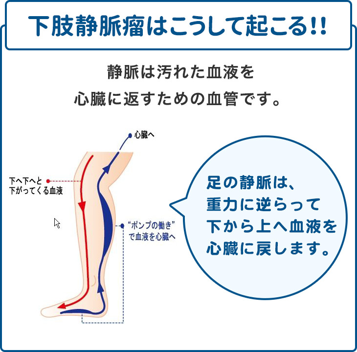 下肢静脈瘤はこうして起こる!!
