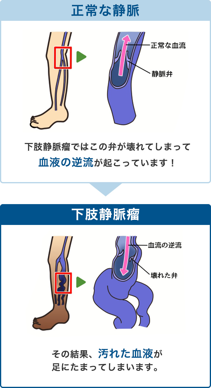 正常な静脈 下肢静脈瘤