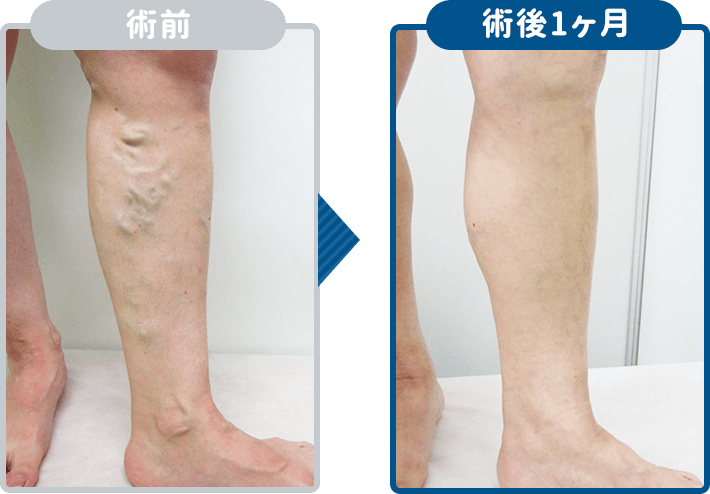 高周波治療の結果