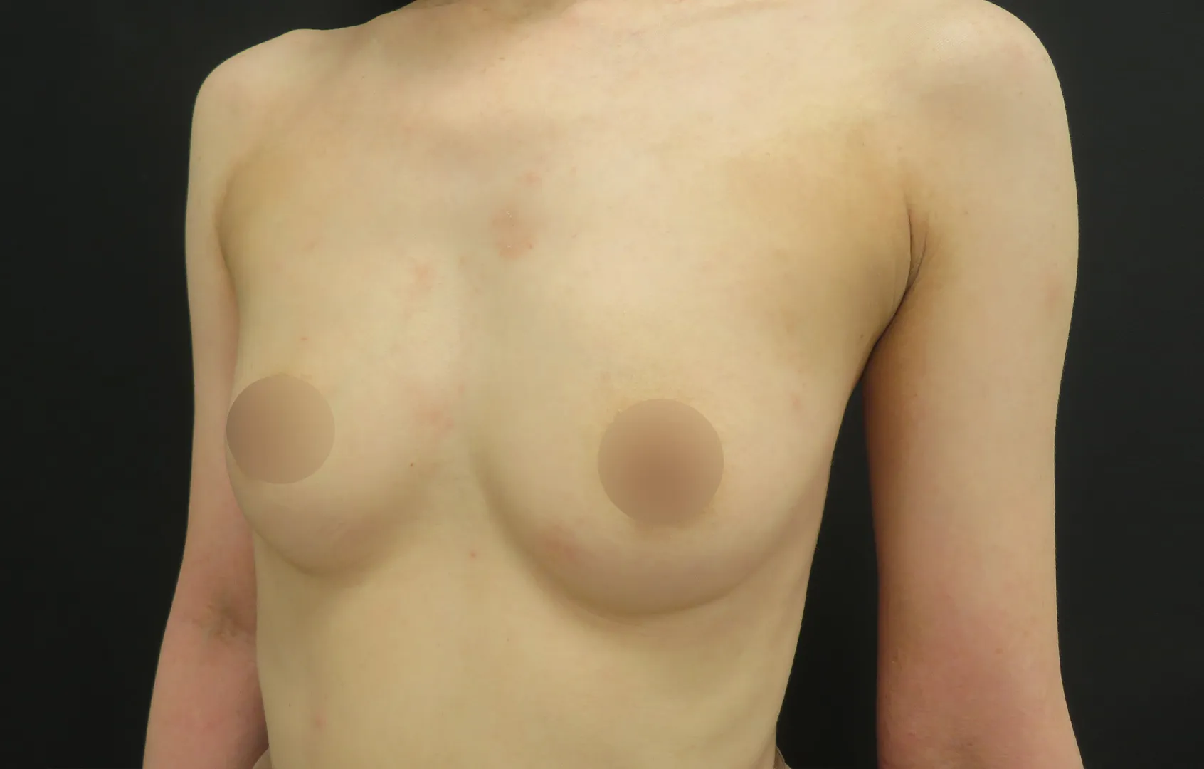 PRP注射お胸の症例写真35（術前）