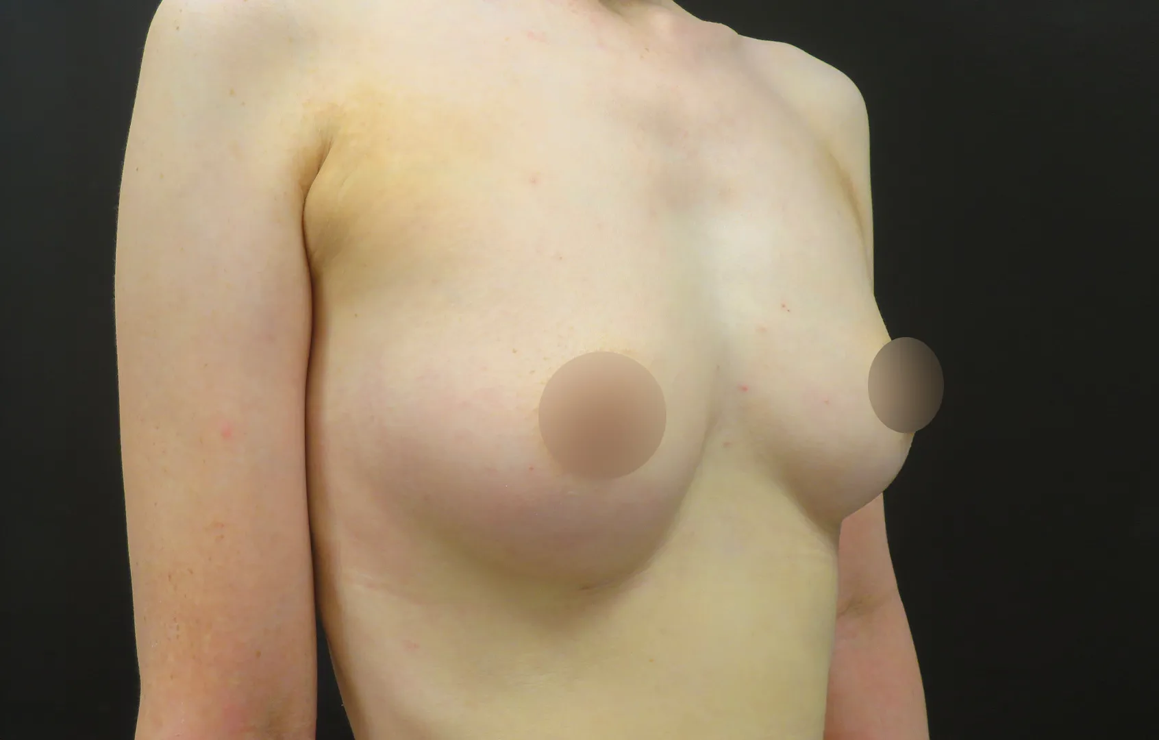 PRP注射お胸の症例写真36（術後）