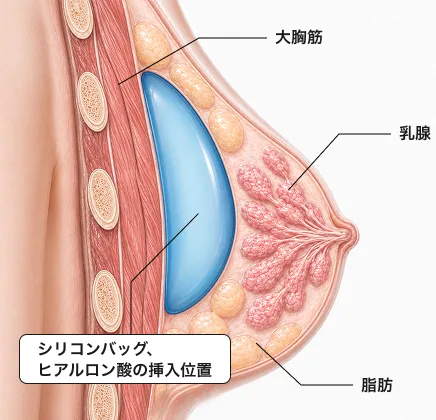 シリコンバッグやヒアルロン酸を乳房下へ注入する従来の豊胸術の図