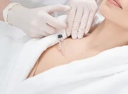 胸元へのPRP注入