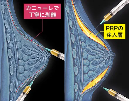 カニューレでPRPの注入層を形成するイメージ