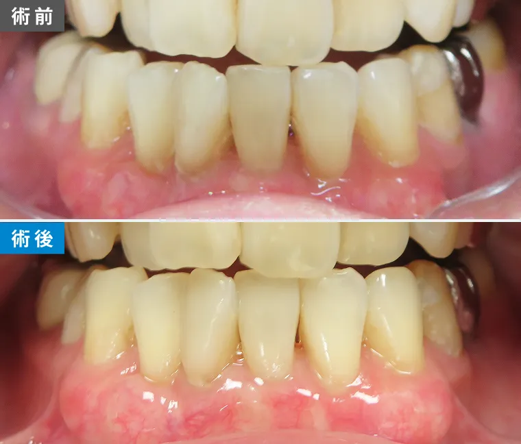 歯肉再生PRP注射の症例写真（術前・術後）