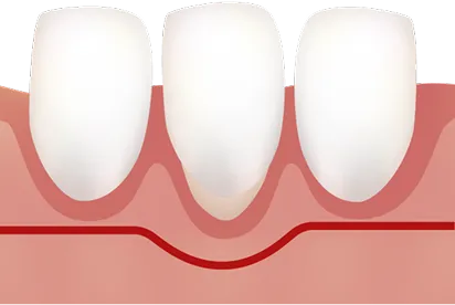 ミラー分類Class1の歯肉退縮