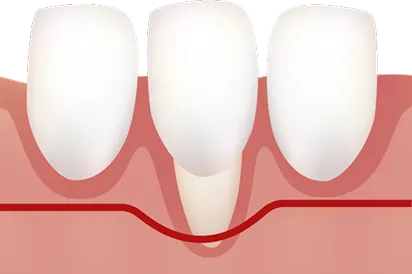 ミラー分類Class2の歯肉退縮