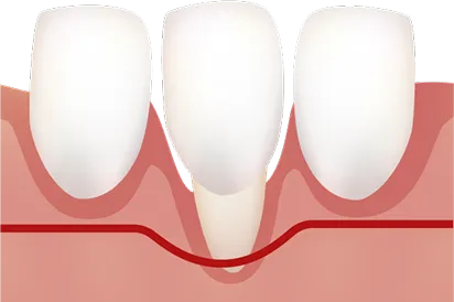 ミラー分類Class3の歯肉退縮