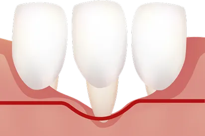 ミラー分類Class4の歯肉退縮