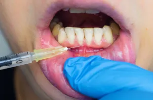 歯ぐきへPRP成長因子を注入し当日帰宅