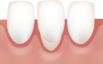 歯肉退縮の状態（歯茎が下がり歯根が露出）