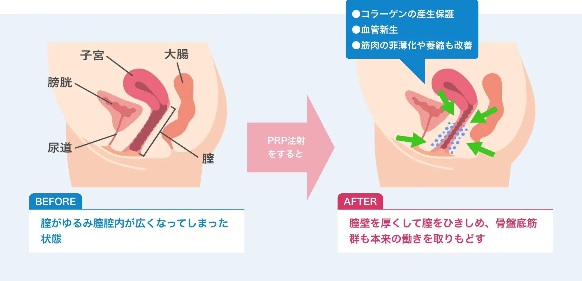 膣壁を厚くして膣をひきしめ、骨盤底筋群も本来の働きを取りもどす