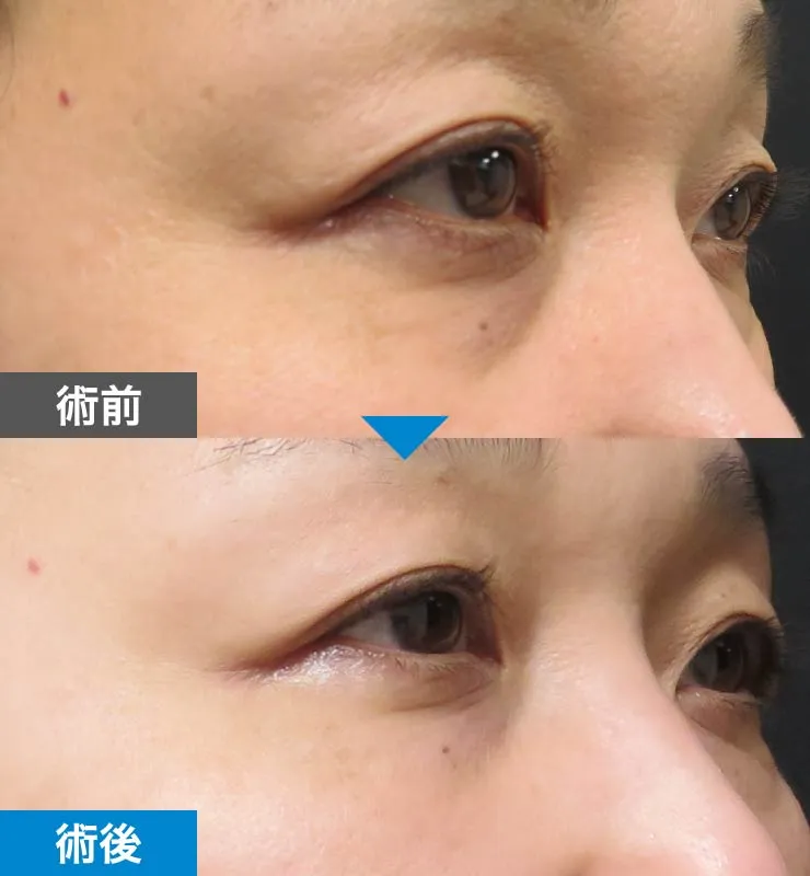 症例 03 術前・術後