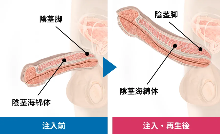 勃起時の陰茎伸長効果