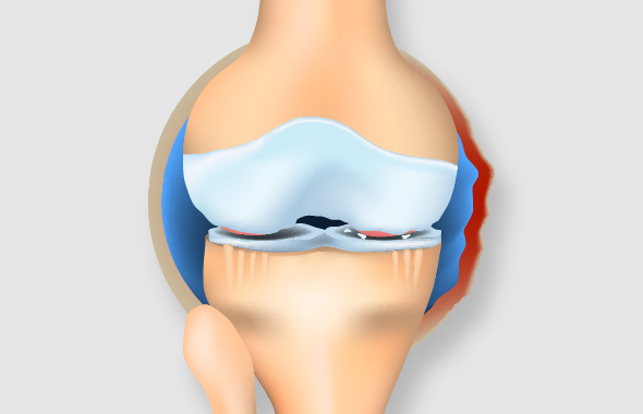 中期のひざ関節