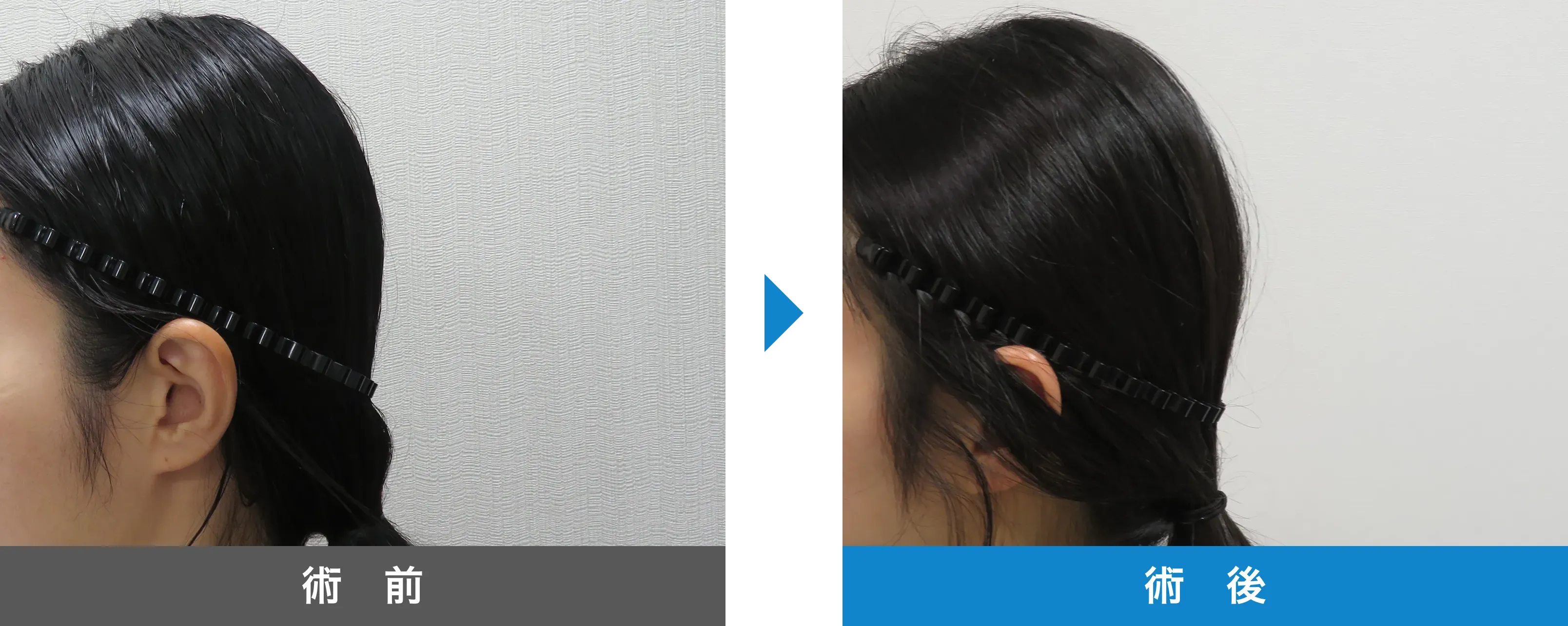 後頭部形成術 症例写真 術後