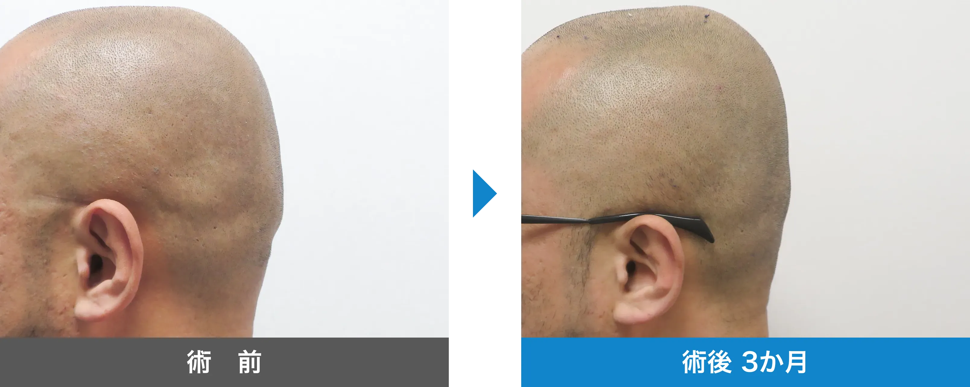 後頭部形成術 症例写真 術後 3か月