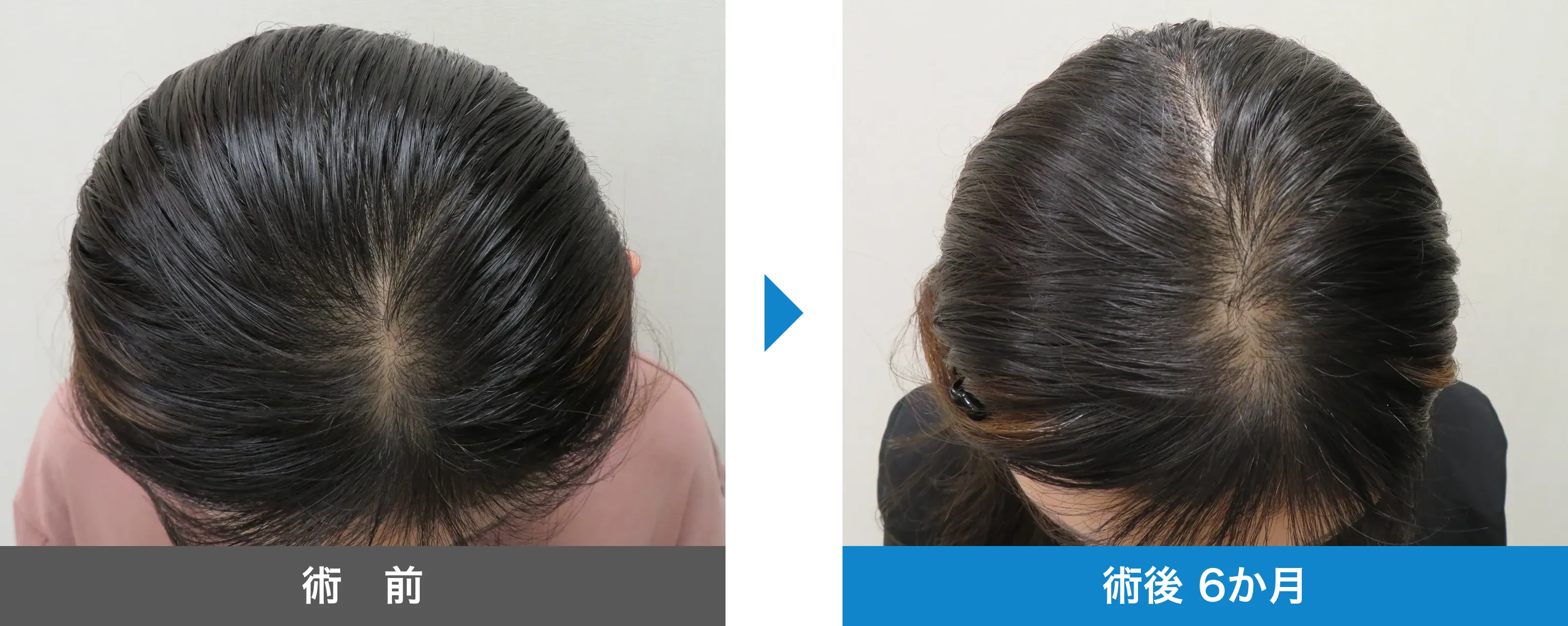 後頭部形成術 症例写真 術後 6か月