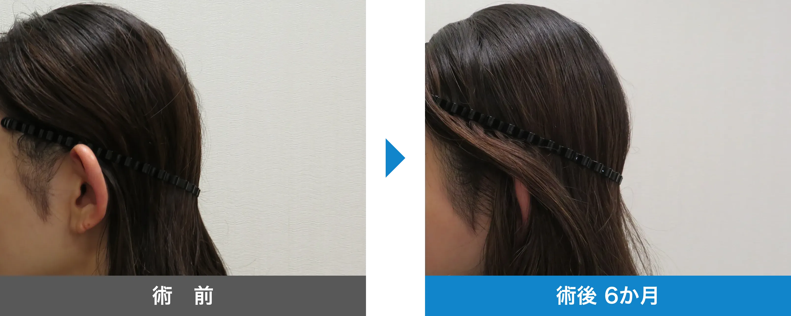 後頭部形成術 症例写真 術後 6か月