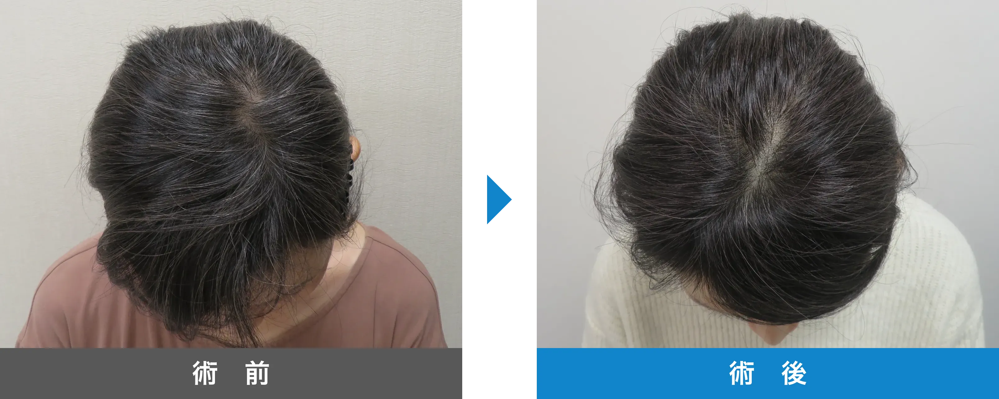 後頭部形成術 症例写真 術後