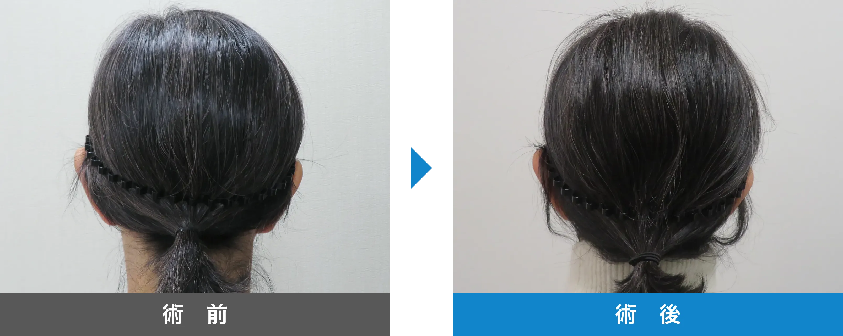 後頭部形成術 症例写真 術後