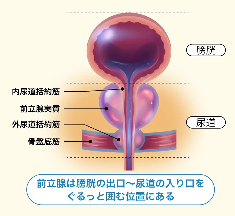 術後の尿もれがリハビリだけでは改善しきれない理由の図解