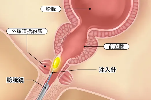 尿道周囲へのPRP注射の図解
